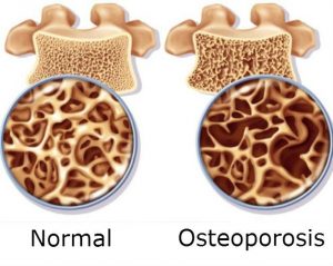 osteoporoza